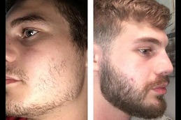 Best Ways to Fix Your Patchy Beard in Dubai UAE