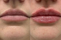 Botox Lip Flip Cost in Dubai & Abu Dhabi UAE