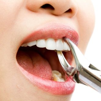 Cheapest Tooth Extraction in Dubai & Abu Dhabi