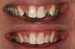 Crowded Teeth Treatment Clinic in Abu Dhabi