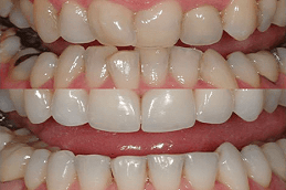 Crowded Teeth Treatment Dubai
