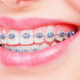 Dental Braces Price in Dubai