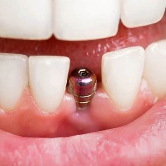 Dental Implants Cost in Dubai