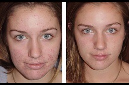 Dermatologist in Dubai for Acne Scars