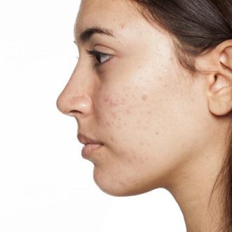 Fractional Laser for Acne Scars Cost in Dubai