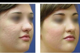 Fractional Laser for Acne Scars Cost in Dubai