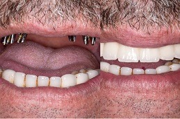 Full Mouth Dental Implants Cost Dubai UAE