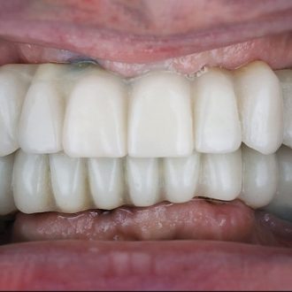 Full Mouth Dental Implants Cost in Dubai UAE