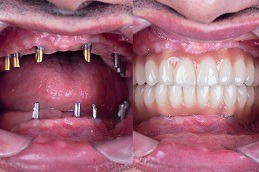 full mought re construction by dental implants and ceramic crown