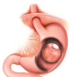 Gastric Balloon for Weight Loss Dubai & Abu Dhabi