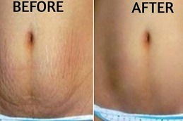 How to Get Rid of Stretch Marks on Stomach Dubai