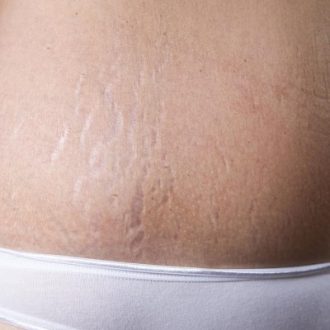 How to Get Rid of Stretch Marks on Stomach in Dubai