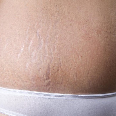 How to Get Rid of Stretch Marks on Stomach in Dubai & Abu Dhabi