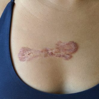 Keloid Removal Cost in Dubai & Abu Dhabi