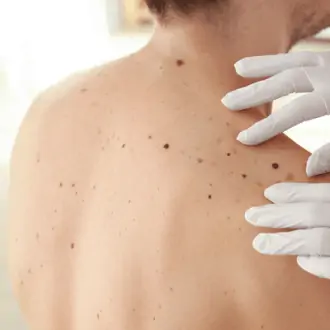 Mole Removal Cost in Dubai | UAE Price