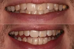 Protruding Teeth Clinic in Abu Dhabi