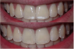 Protruding Teeth Clinic in Dubai