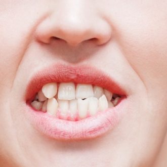 Protruding Teeth Treatment Cost in Dubai
