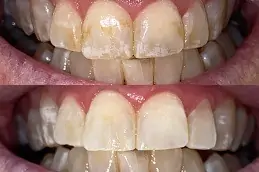 Protruding Teeth in Abu Dhabi