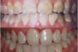 Protruding Teeth in Dubai & Abu Dhabi