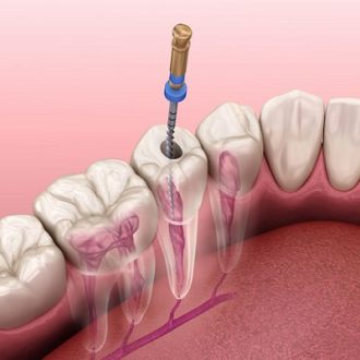 Root Canal Therapy Clinic in Dubai & Abu Dhabi