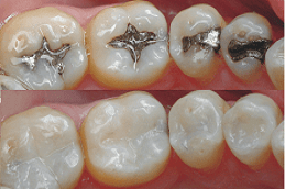 SMART Dental Amalgam Removal in Abu Dhabi
