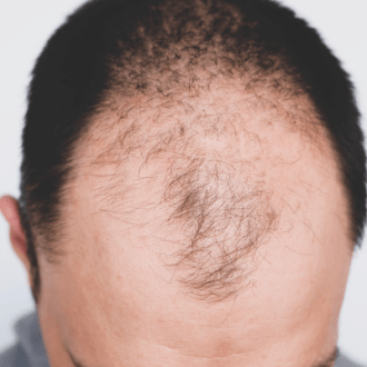 Say No to Baldness with Enfield Royal Clinic