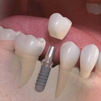 Single Tooth Implant Cost in Dubai & Abu Dhabi