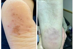 Skin Wart Removal Cost Dubai & Abu Dhabi