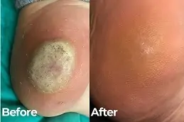 Skin Wart Removal Cost in Dubai & Abu Dhabi