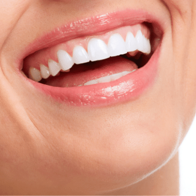 Teeth Straightening and Alignment Cost in Dubai