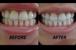 Teeth Whitening Strips Cost Dubai & Abu Dhabi