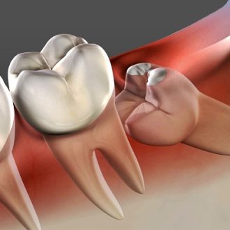 Wisdom Tooth Extraction Cost in Dubai & Abu Dhabi