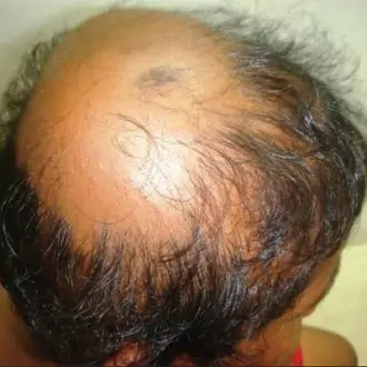 Alopecia Areata Treatment Cost in Dubai