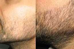 Best Beard Transplant Cost Dubai & Abu Dhabi