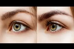 Best eyelash-hair-transplant-cost Clinic in Dubai
