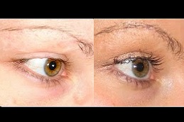 Best eyelash-hair-transplant-cost in Abu Dhabi