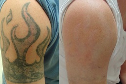 Best how-long-after-laser-tattoo-removal-can-i-get-a-cover-up Clinic in Dubai