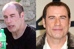 Celebrities Who Have Done best Hair Transplants Dubai