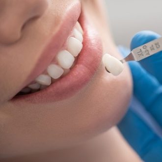 Ceramic Dental Crown Cost in Dubai & Abu Dhabi