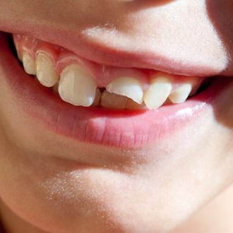 Cracked Tooth After Root Canal Can it be Saved