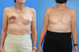 DIEP Flap Breast Reconstruction Clinic Dubai