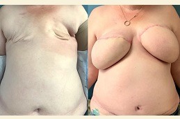 DIEP Flap Breast Reconstruction Dubai