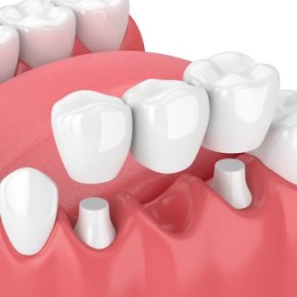 Dental Crowns and Bridges Cost in Dubai