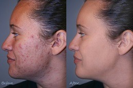Does HydraFacial Work for Acne Scars in Dubai