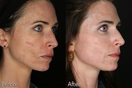 Does best clinic of HydraFacial Work for Acne Scars in Dubai