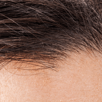 Hair Transplant for Grey Hair in Dubai & Abu Dhabi