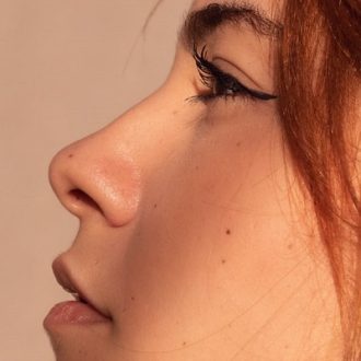 How to Get Rid of Bump on Nose Bridge?