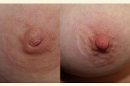 Inverted Nipple Surgery Clinic in Abu Dhabi
