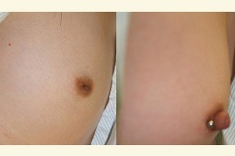 Inverted Nipple Surgery Clinic in Dubai & Abu Dhabi